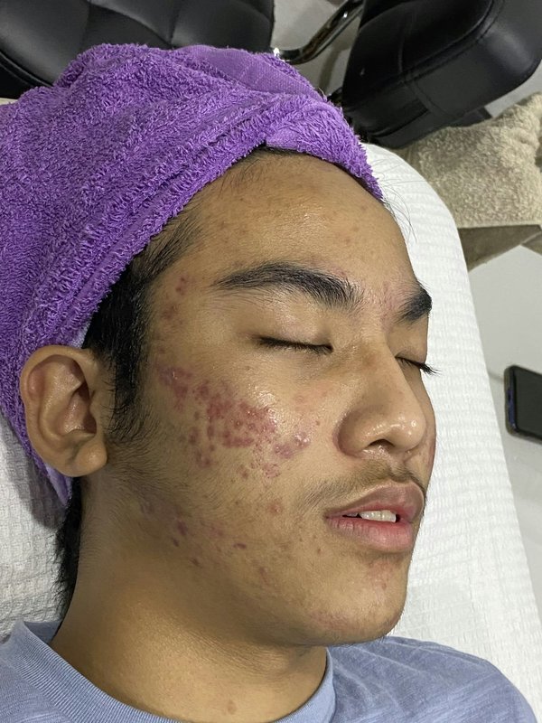 Quelles sont les dernières avancées en matière de traitement de l'acné chez les adolescents?